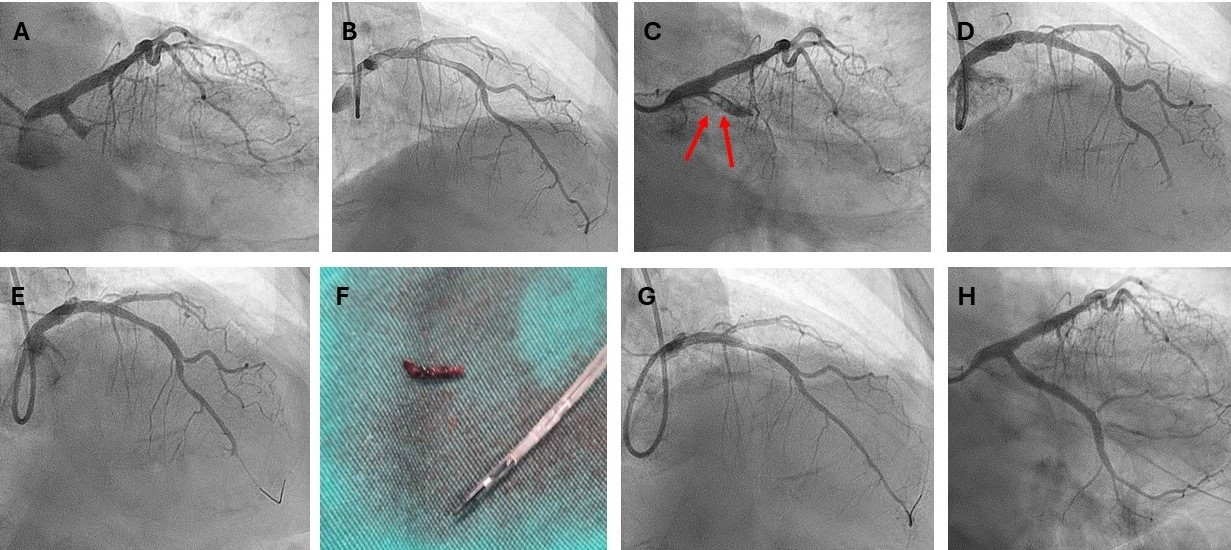 Figure. (A) Coronary angiogram from the PA caudal view
